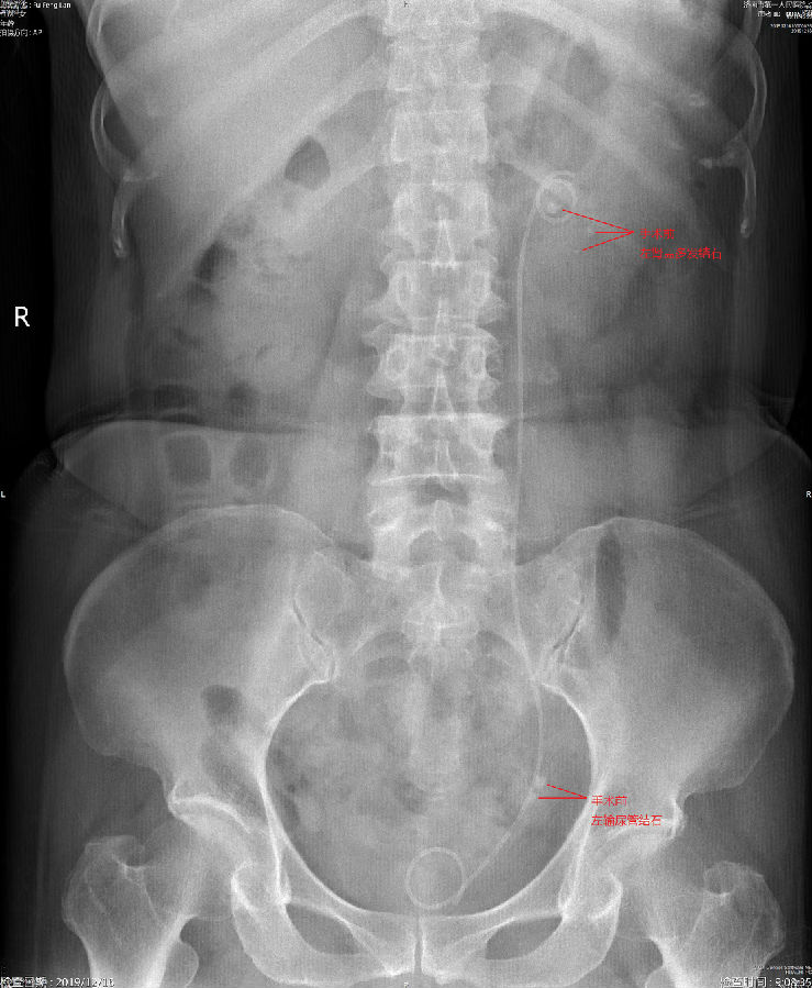 手术前x线片:示左肾盂,左输尿管多发结石